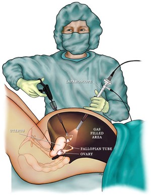 picture of laparoscopy surgery